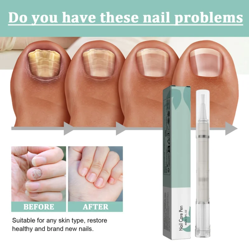 Nail Fungus Treatment Pen 4ml Amz Wx2m4767 4